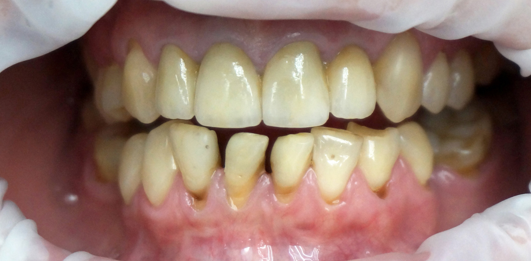 Metamorfoza uśmiechu wada zgryzu wrocław