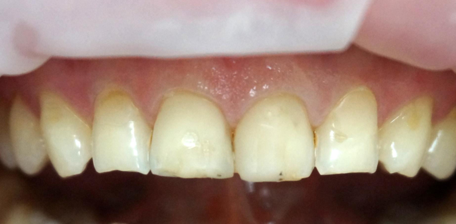 Metamorfoza uśmiechu w jeden dzień