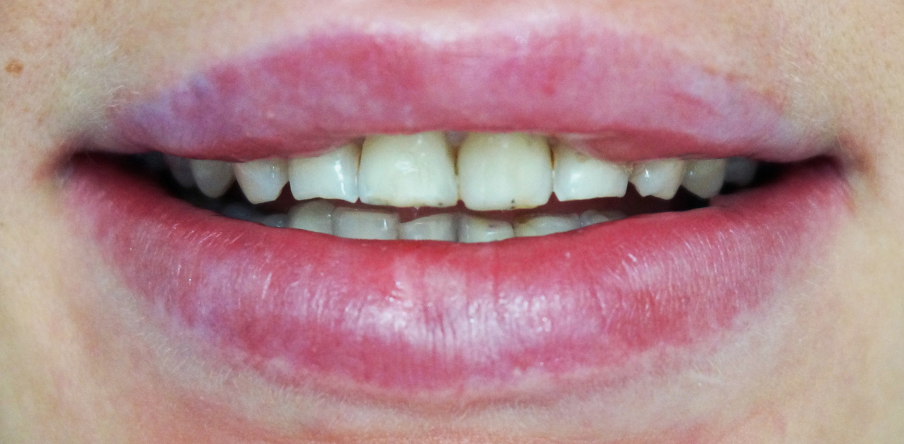 Metamorfoza uśmiechu w jeden dzień - Klinika Platinum - Wrocław