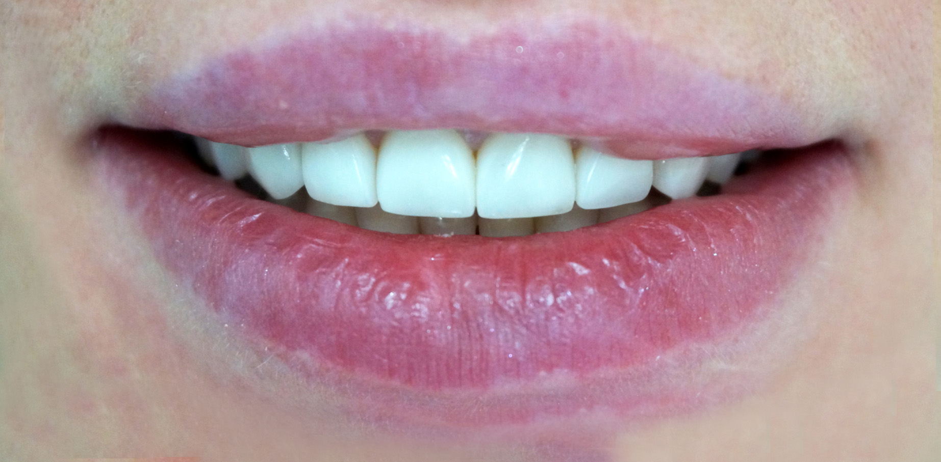 Metamorfoza uśmiechu w jeden dzień - Klinika Platinum - Wrocław