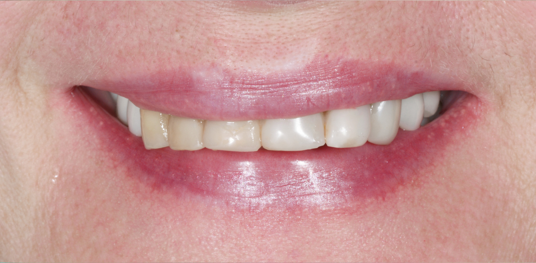 Metamorfoza uśmiechu w jeden dzień - Klinika Platinum - Wrocław