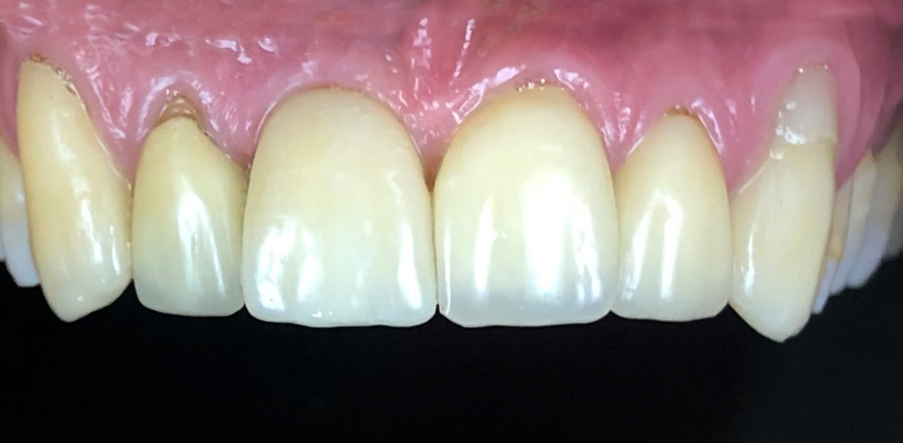 Leczenie zębów Wrocław w jeden dzień