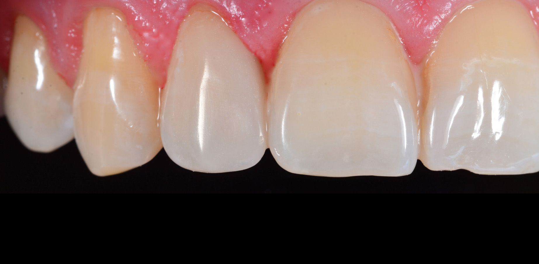 metamorfoza uzębienia - wrocław