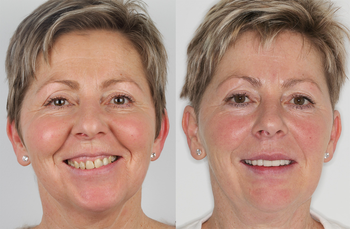 metamorfoza uśmiechu klinika platinum wroclaw