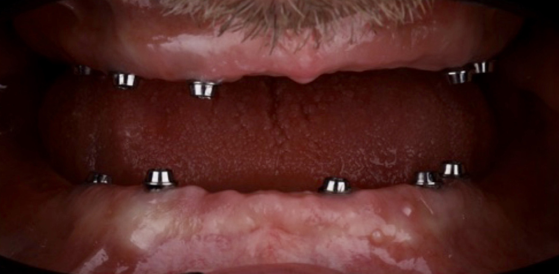 Implanty wrocław - leczenie zębów