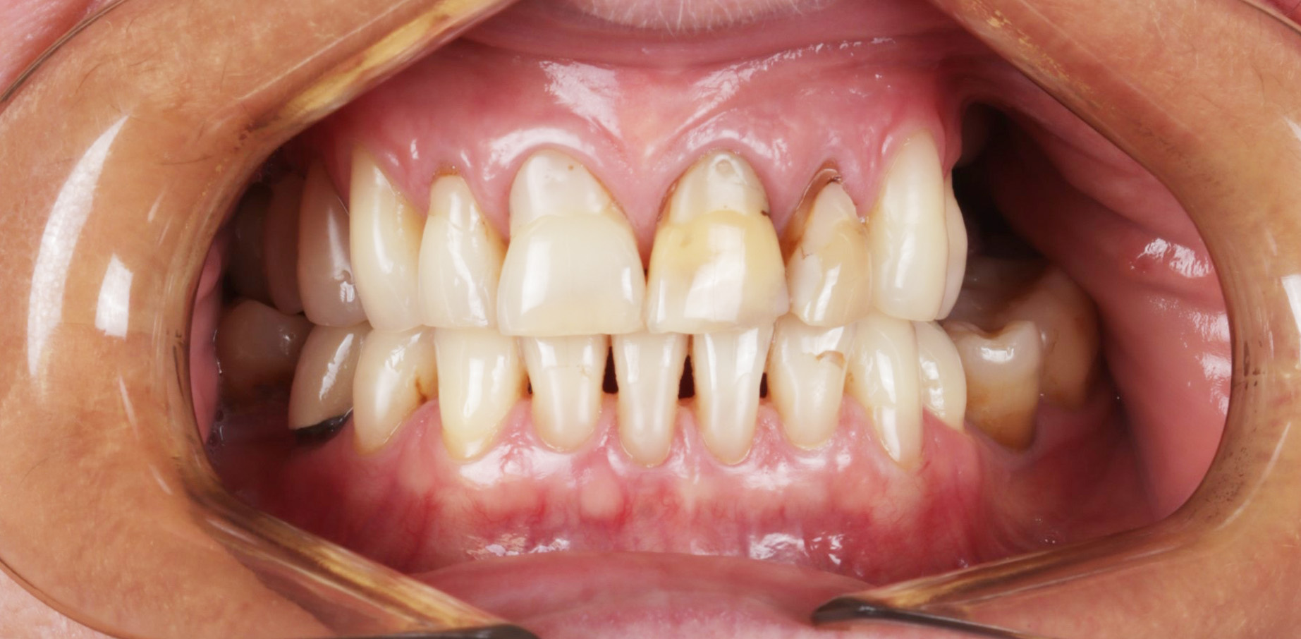 Ubytki zębowe - leczenie zębów - Wrocław