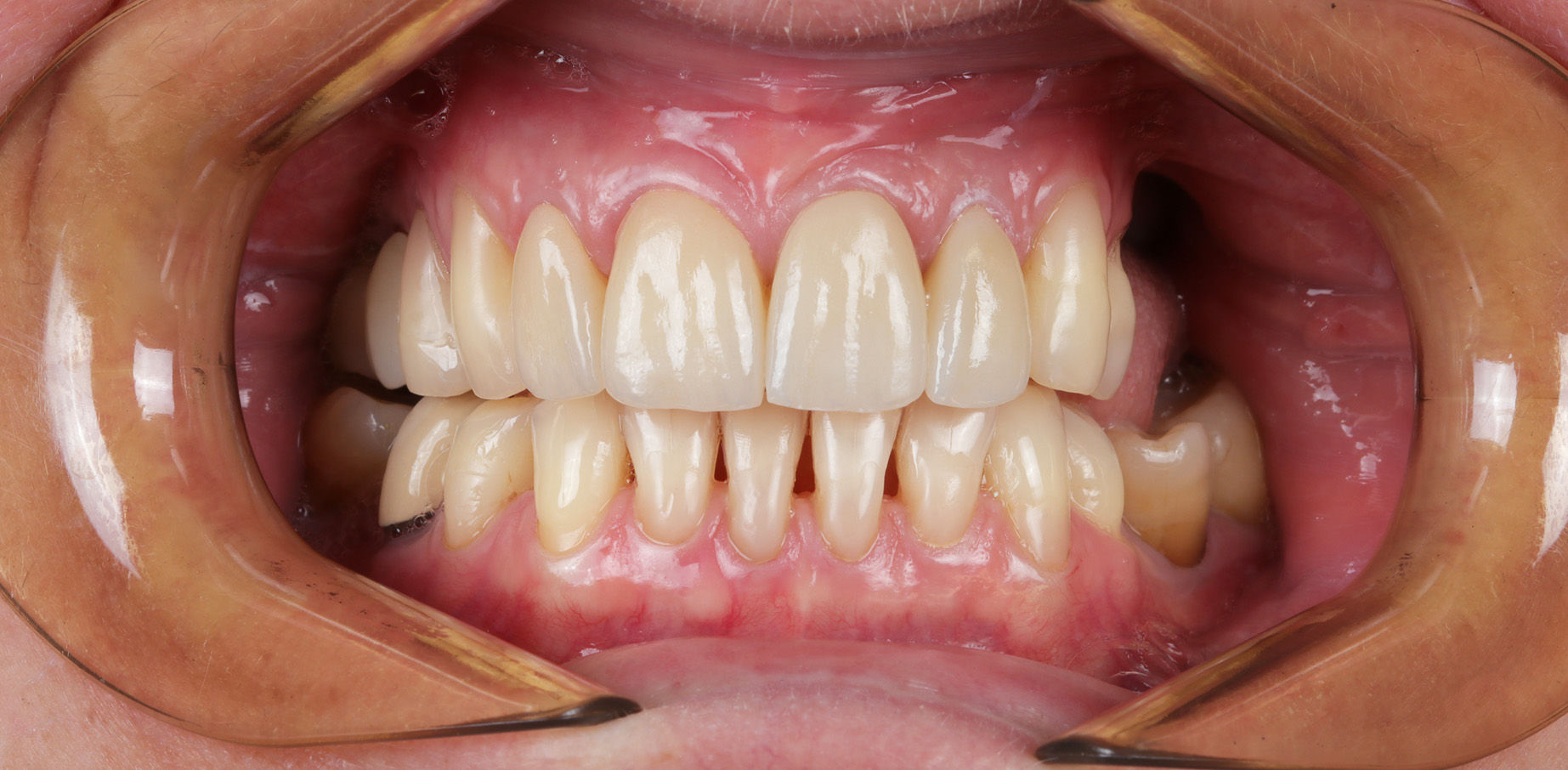 Ubytki zębowe - leczenie zębów - Wrocław