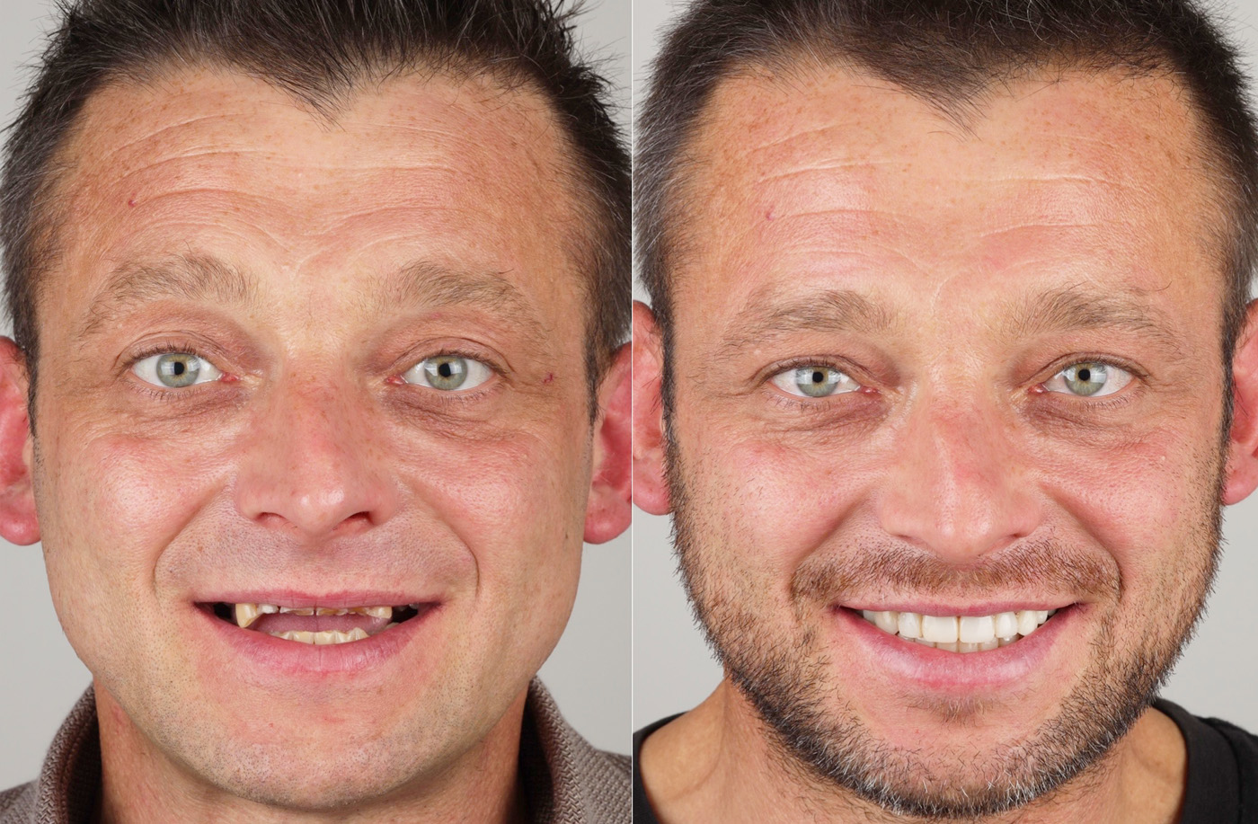 metamorfoza uśmiechu klinika platinum wroclaw 3